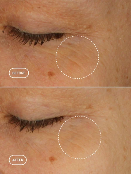 Before and after results